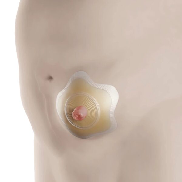 SenSura Mio Click Convex Flip Ostomy Barrier, 35 mm Stoma, Red Match - 2 Piece, Extended Wear, Precut Design - Image 5